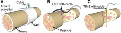 Update on Peripheral Nerve Electrodes for Closed-Loop Neuroprosthetics